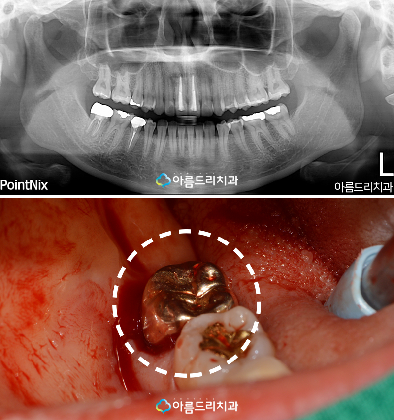 치아재식술 자연치아 살리기 후기 관련 이미지 3