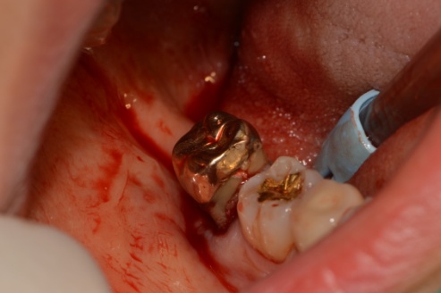 [신논현 치과] 임플란트 대신 치아재식(아름드리치과) 관련 이미지 5
