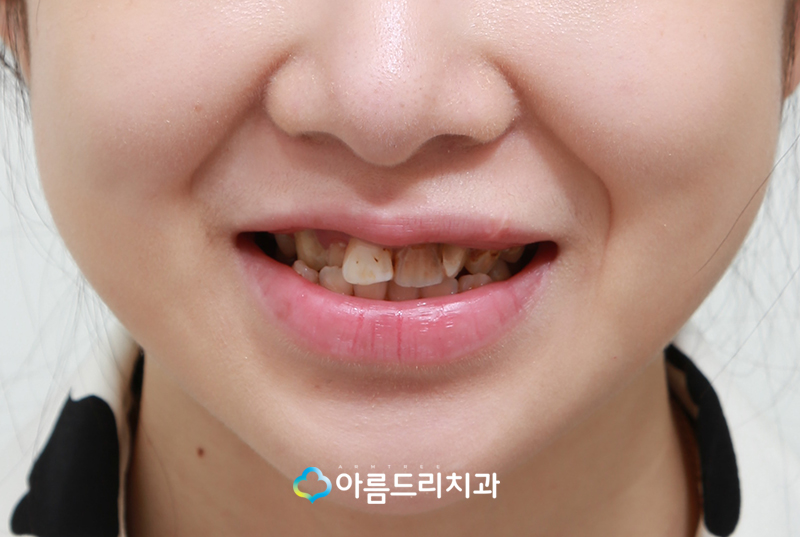 못생긴 앞니 치아라미네이트로 빠르게 관련 이미지 4