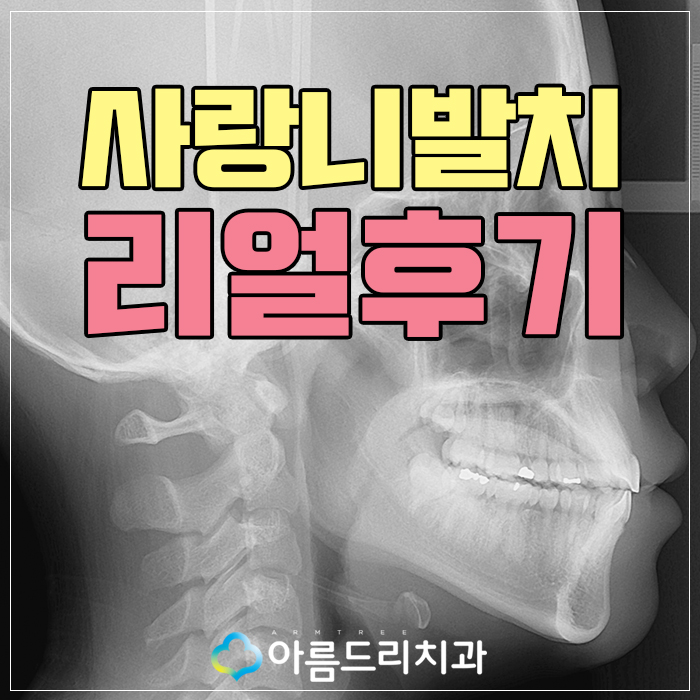 매복사랑니 발치 과정 주의사항 관련 이미지 1