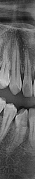 반포치과 사랑니발치 치과를 찾고있다면 관련 이미지 8