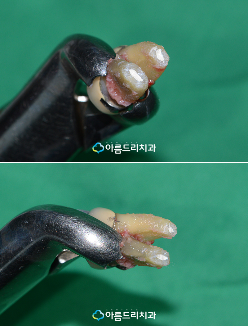 잇몸고름주머니 잇몸에고름 치아재식술 치료 관련 이미지 7