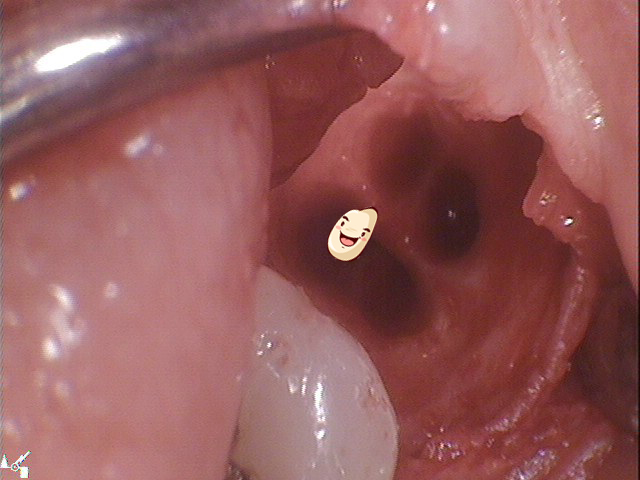 강남 아름드리치과 수술 발치_매복치 신논현치과 관련 이미지 7