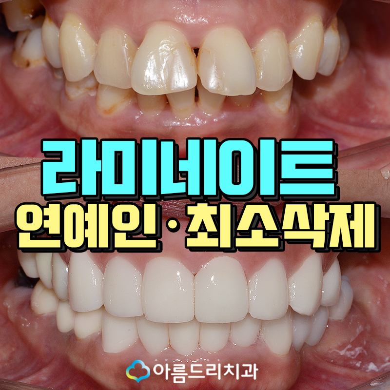 라미네이트연예인 이빨(치아) 최소삭제 이거다 관련 이미지 1
