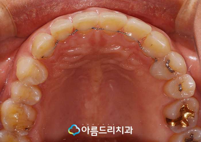 앞니벌어짐 부분교정으로 빠르게 관련 이미지 8
