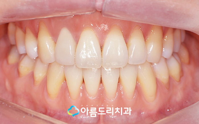 실활치미백 - 앞니변색을 해결하는 치료 관련 이미지 10