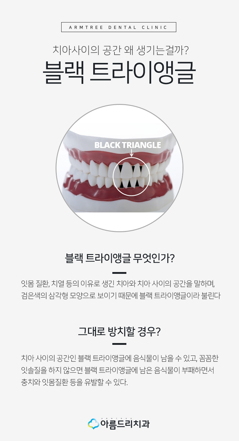 앞니 블랙트라이앵글 치아 이성형으로 해결 관련 이미지 3