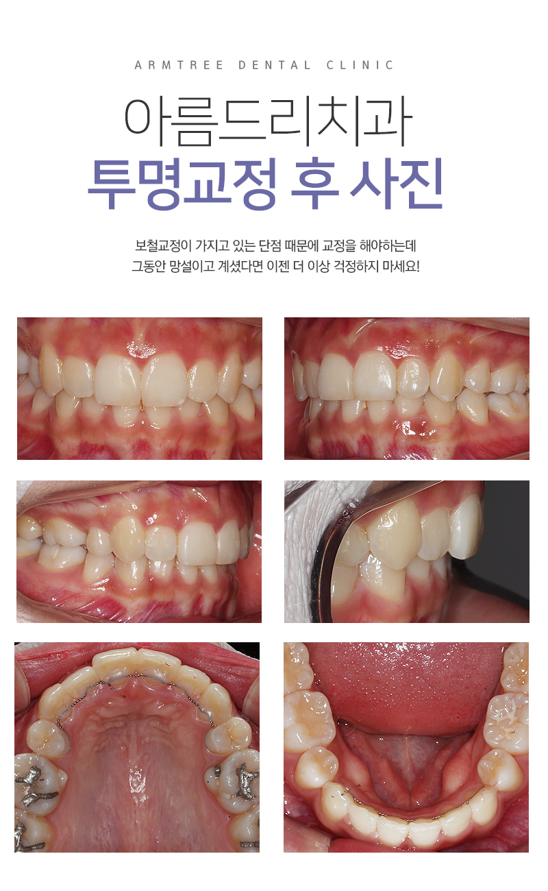 투명교정통증 부작용은 과연? 관련 이미지 6