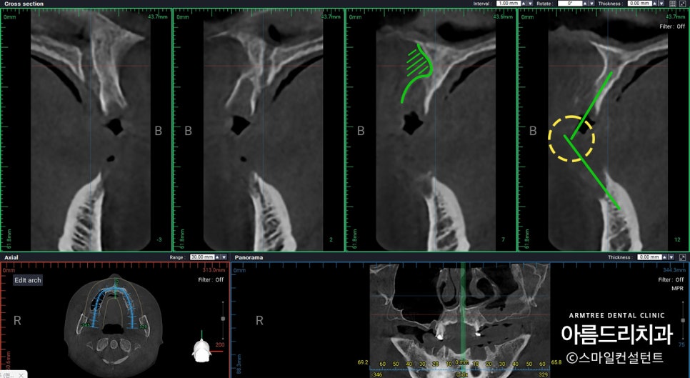 전체임플란트 전악임플란트 전후 아름드리치과 진료일기 관련 이미지 9