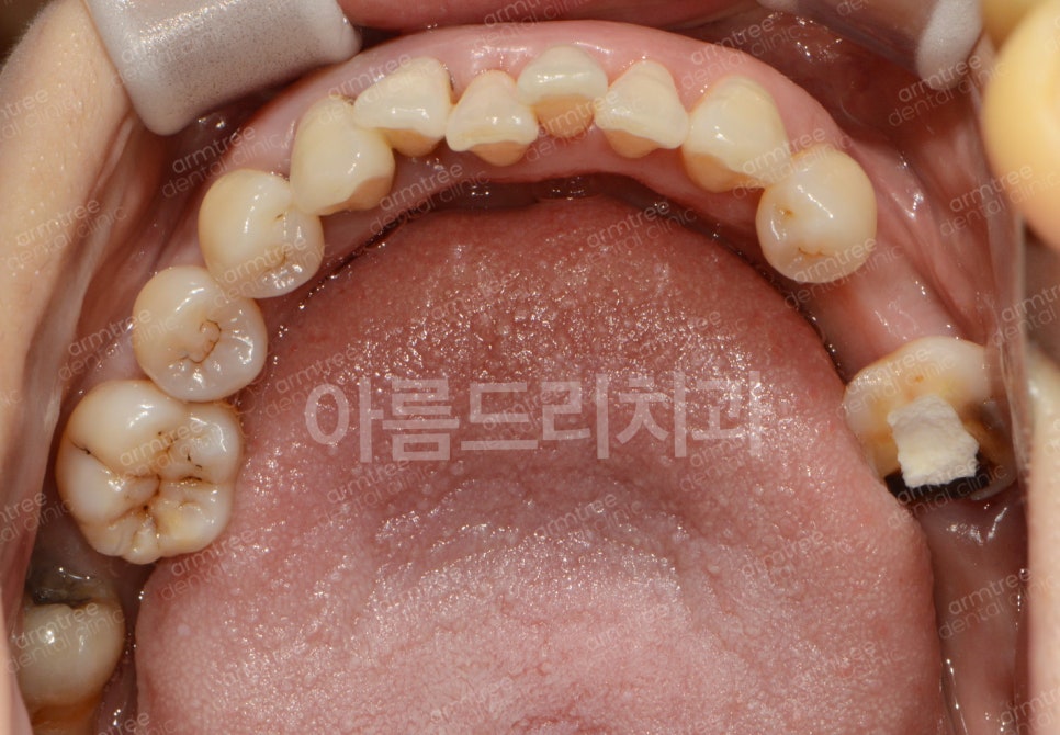 왜 임플란트와 치아교정을 다 잘아는 곳에서 치료해야할까?| 아름드리치과 진료일기 관련 이미지 4