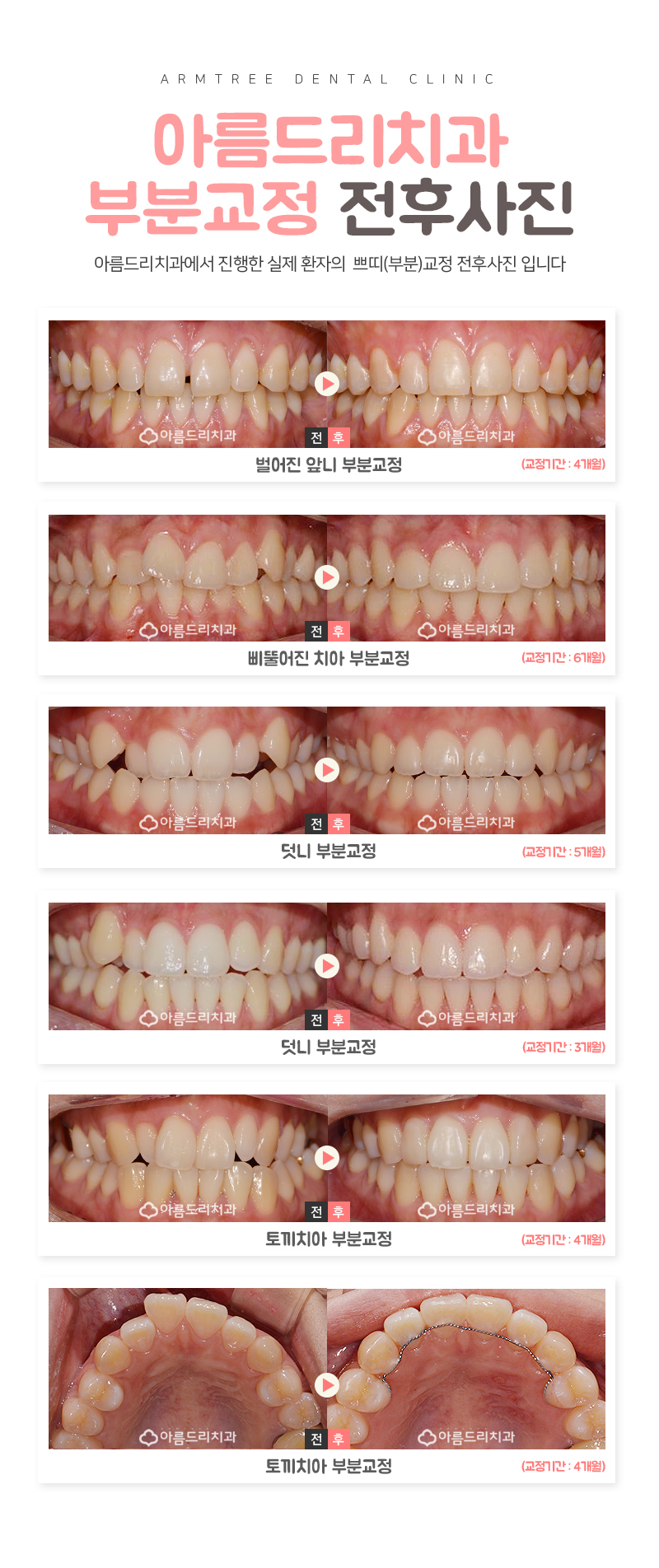 앞니벌어짐 교정 부분교정 후기가 말한다 관련 이미지 7