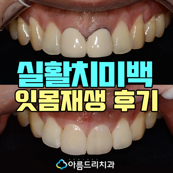 실활치미백 치은 잇몸퇴축 재생으로 동안치아 관련 이미지 1