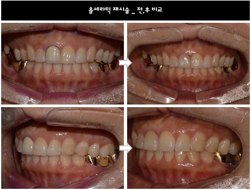 앞니 올세라믹 _재시술 (잇몸변색,메탈노출) 관련 이미지 9