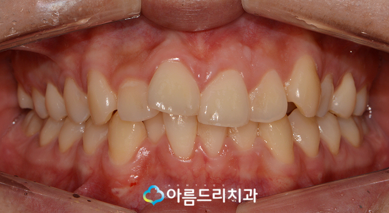 부분 설측교정비용 후기가 좋은 치과 관련 이미지 4