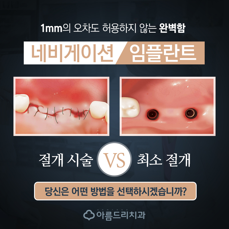 원데이임플란트 당일즉시 가즈아! 관련 이미지 4