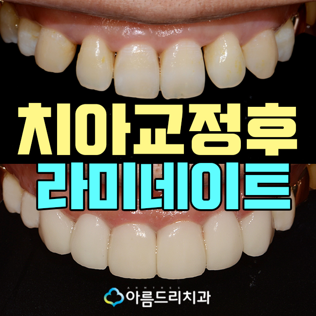 라미네이트교정 최소삭제 치아성형 후기 관련 이미지 1
