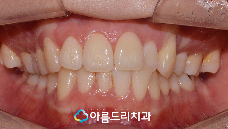 치아부정교합교정 악궁확장장치 후기는? 관련 이미지 3