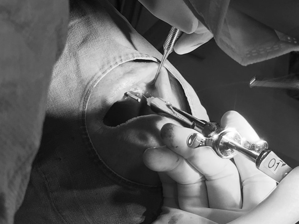 앞니 임플란트_뼈이식_신논현역 치과_아름드리 치과 관련 이미지 19