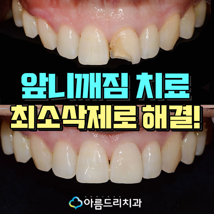앞니깨짐 치료 최소삭제라미네이트 리얼후기 관련 이미지 1