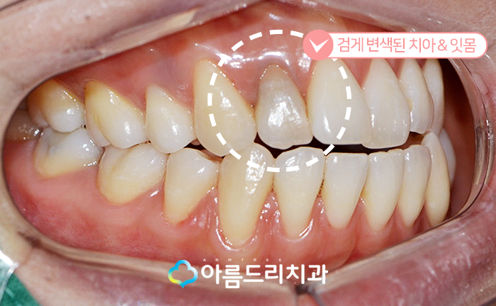 실활치미백 - 앞니변색을 해결하는 치료 관련 이미지 4