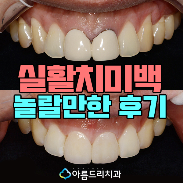 실활치미백 앞니변색까지 해결! 관련 이미지 1