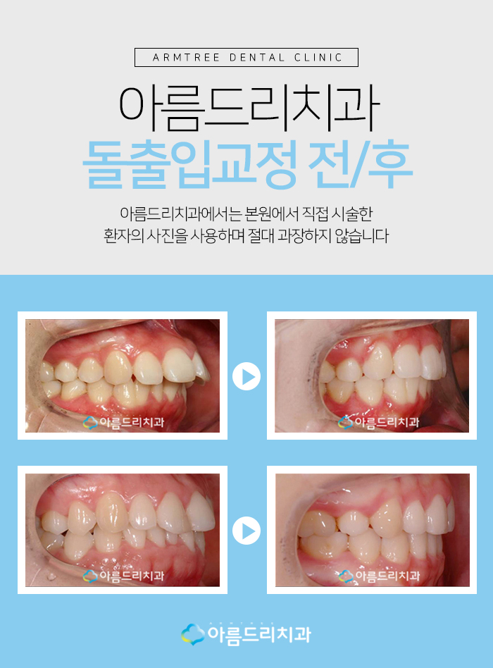 치아교정돌출입 교정후기가 중요햇 관련 이미지 7