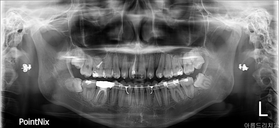 강남 아름드리치과 수술 발치_매복치 신논현치과 관련 이미지 2