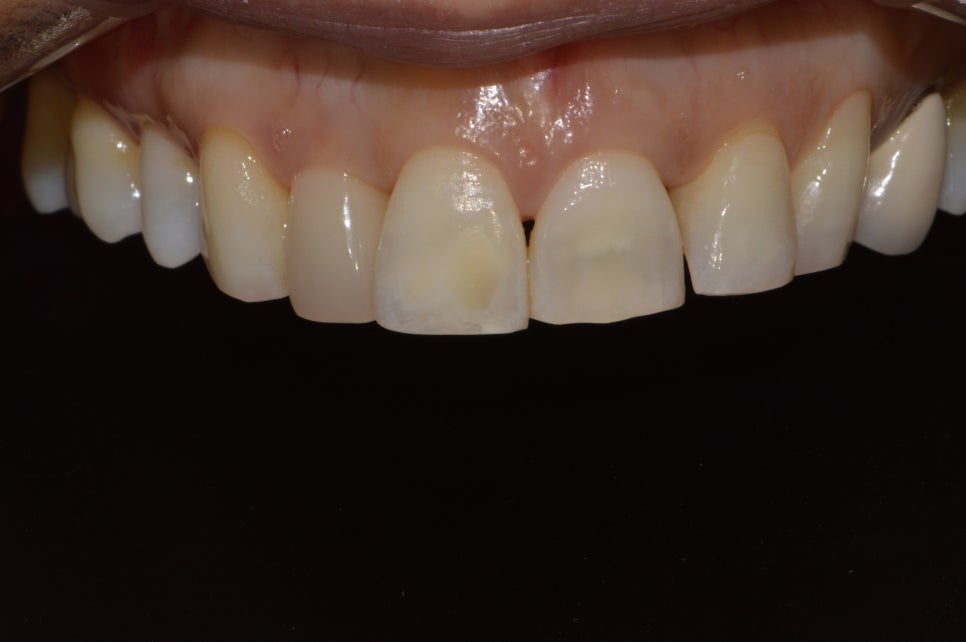 [신논현 치과] 3D 구강 스캐너_정확하게 본뜨기 관련 이미지 14