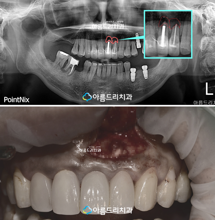 치근단절제술 후기로보는 완벽함 관련 이미지 3