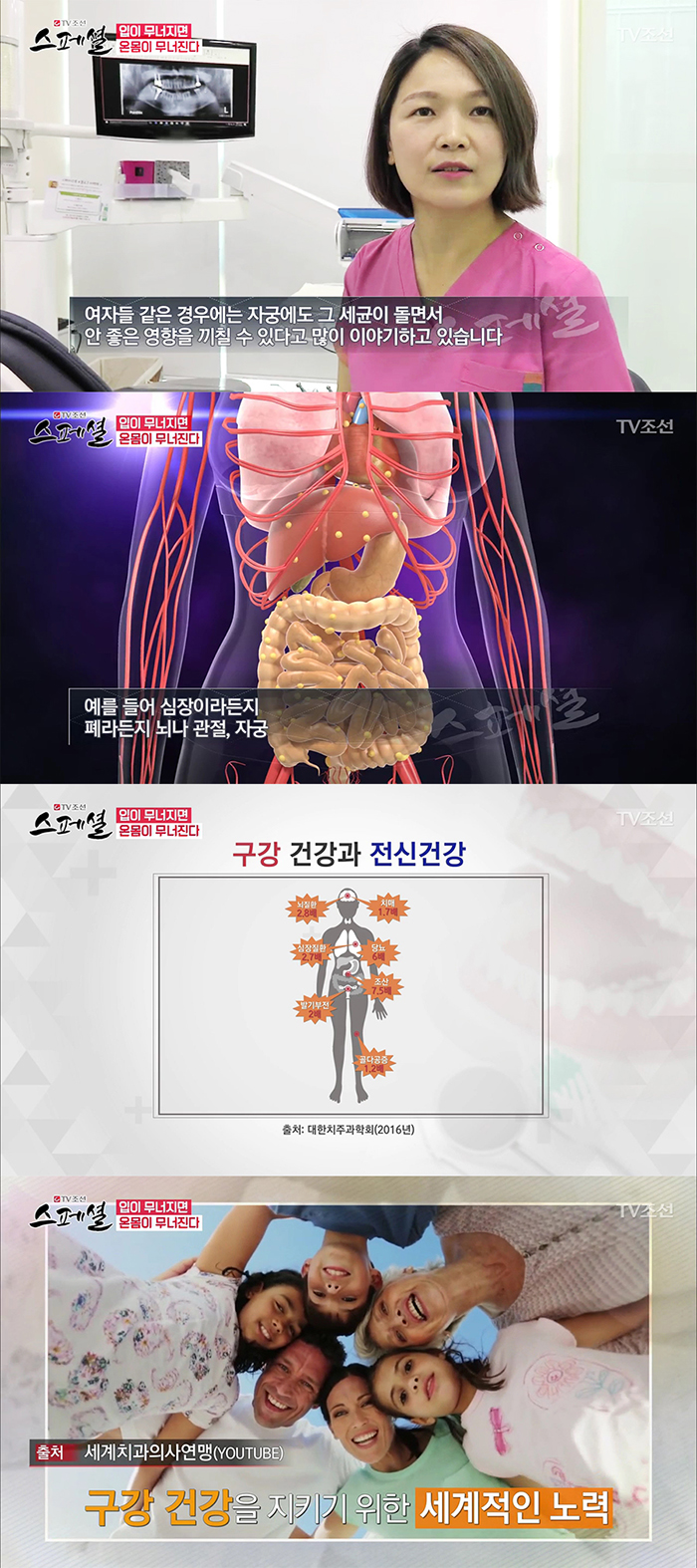 TV조선 스페셜 50회 구강건강관리 관련 이미지 10