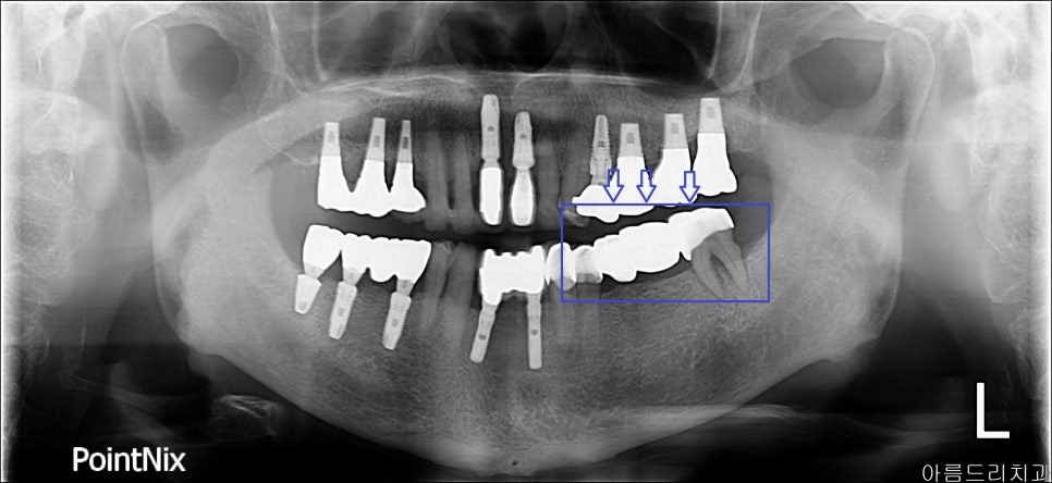 신논현역치과 PRF 자가혈 임플란트. 안전한 임플란트_아름드리 치과 관련 이미지 3
