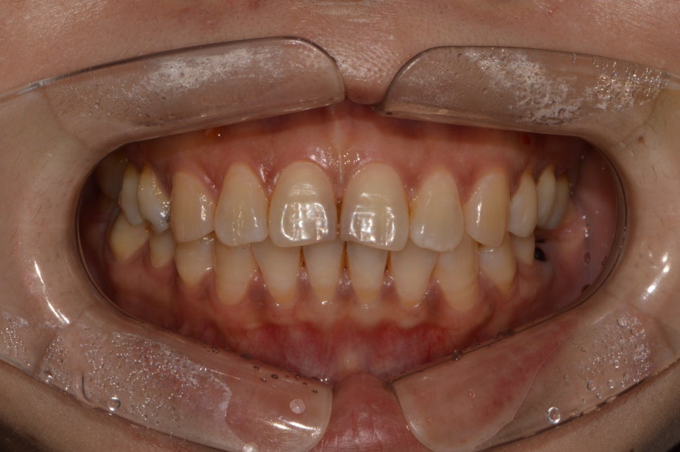 [신논현 치과] 3D 구강 스캐너_정확하게 본뜨기 관련 이미지 12