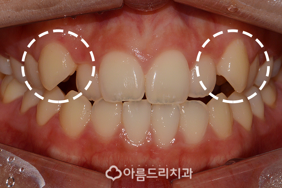 앞니부분교정기간 후기의 변화 관련 이미지 2