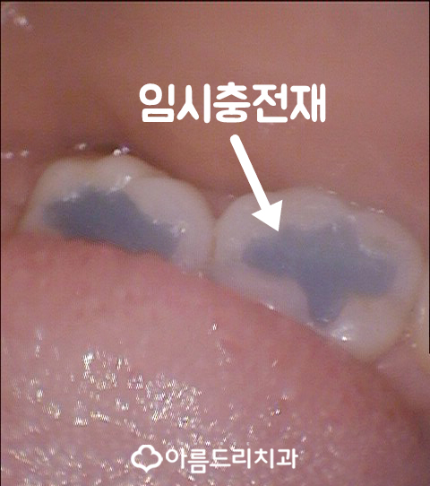 충치인레이 아말감주변 충치치료는? 관련 이미지 9