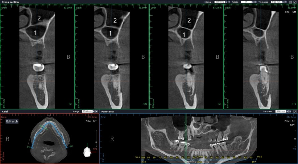 무절개 무봉합 상악동 거상술 관련 이미지 2