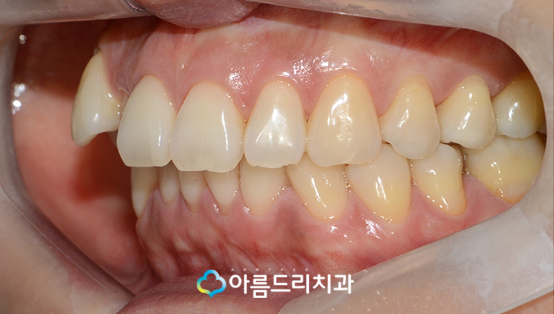 드라큘라이빨 송곳니교정 부분교정후기 관련 이미지 5
