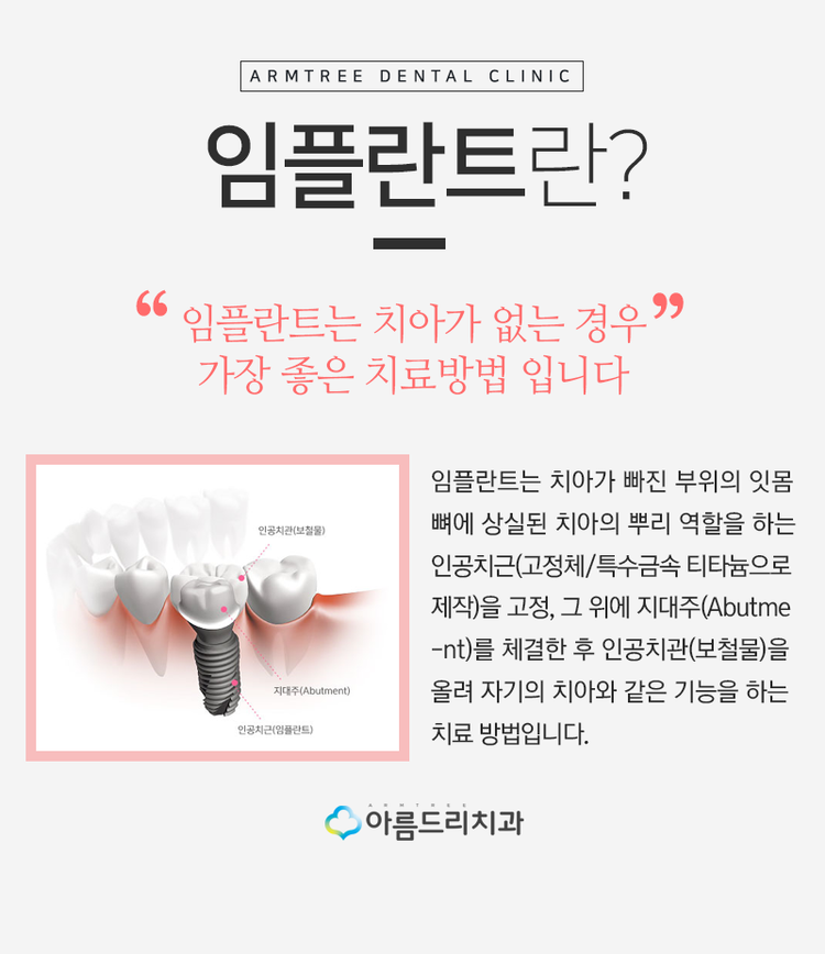 네비게이션임플란트 부작용은 저리가 관련 이미지 2