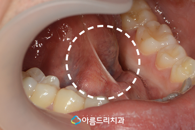 성인설소대수술 후기 단축증 해결 관련 이미지 5