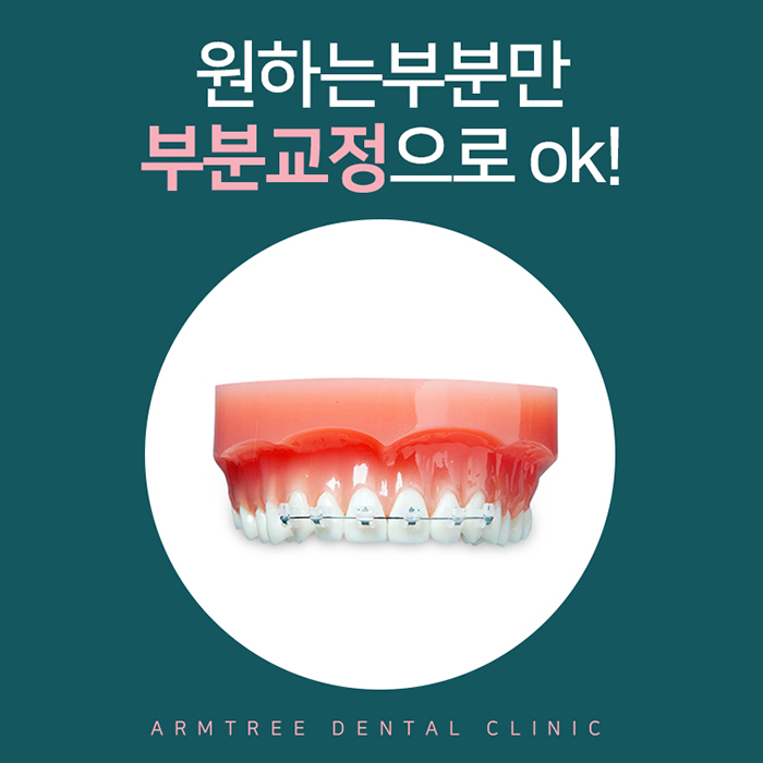 윗니교정 비용 알아볼까? 관련 이미지 3