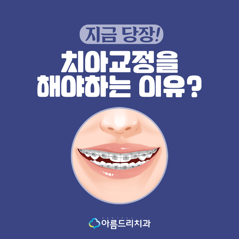 이교정비용 종류 중요한것은? 관련 이미지 1