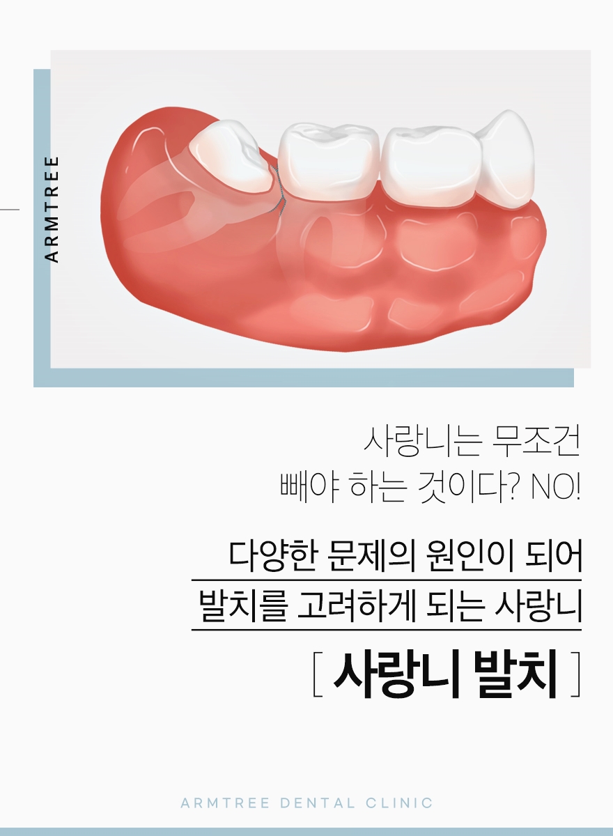 신논현 사랑니발치치과 선택은 신중해야만 관련 이미지 2