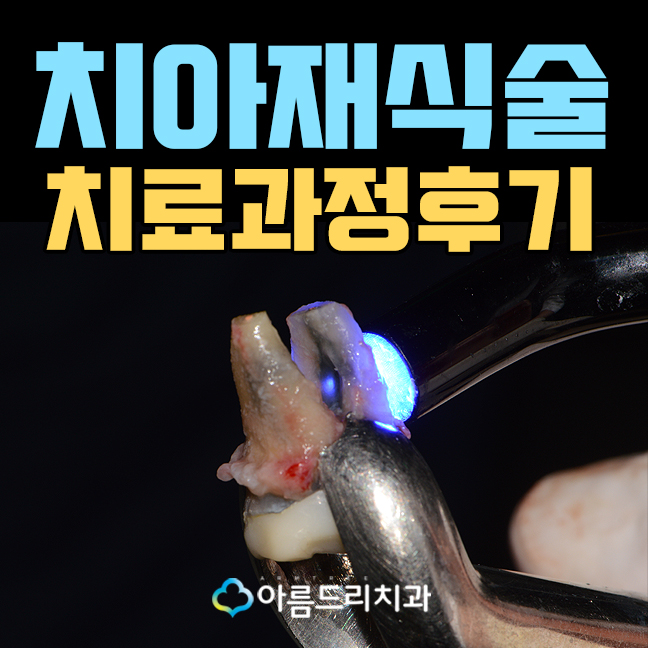 치아재식술 치료후기 자연치아살리기 관련 이미지 1