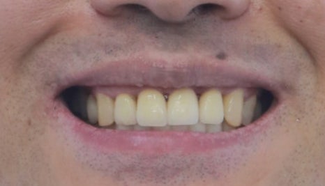 부분교정+임플란트(진료일기) 관련 이미지 10