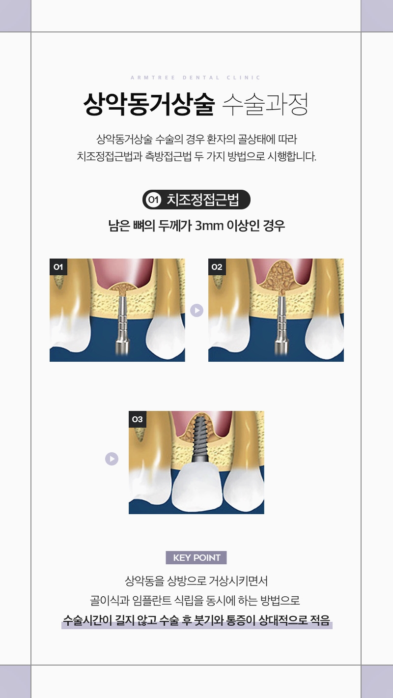 상악동거상술 통증이 걱정된다면 관련 이미지 4