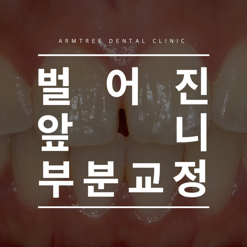 벌어진앞니교정 아름드리치과에서 고민해결 관련 이미지 1