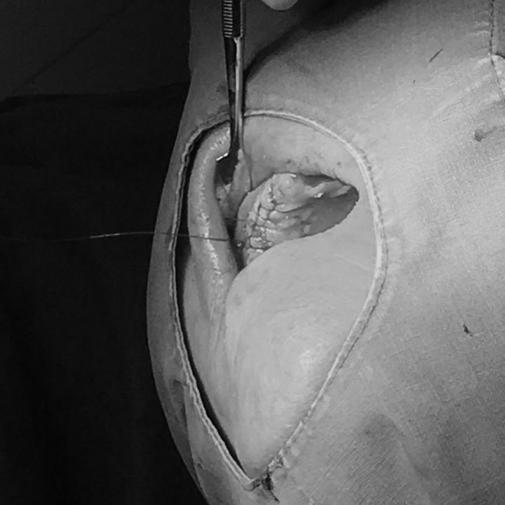 앞니 임플란트_뼈이식_신논현역 치과_아름드리 치과 관련 이미지 23