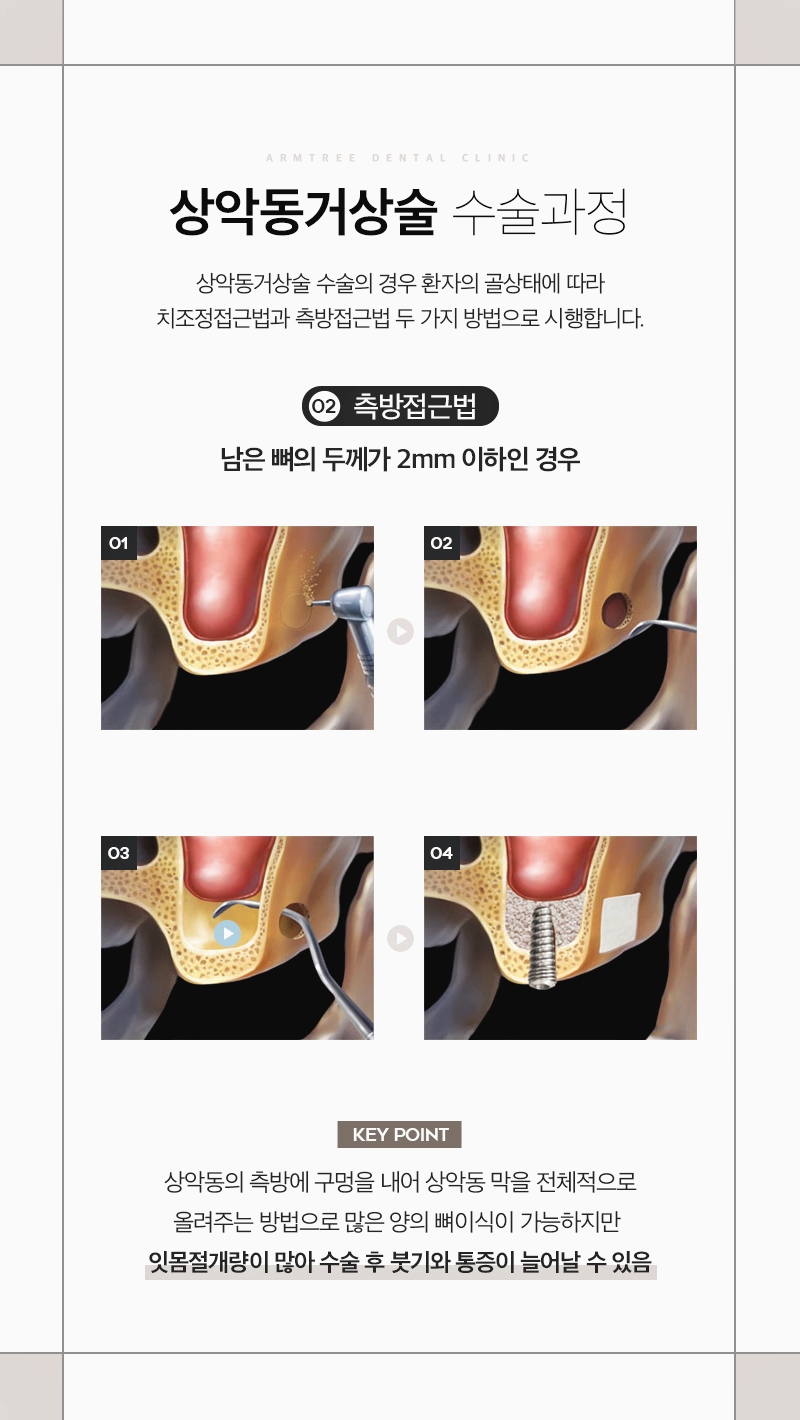 신논현역 상악동거상술 임플란트 아름드리치과는 관련 이미지 5