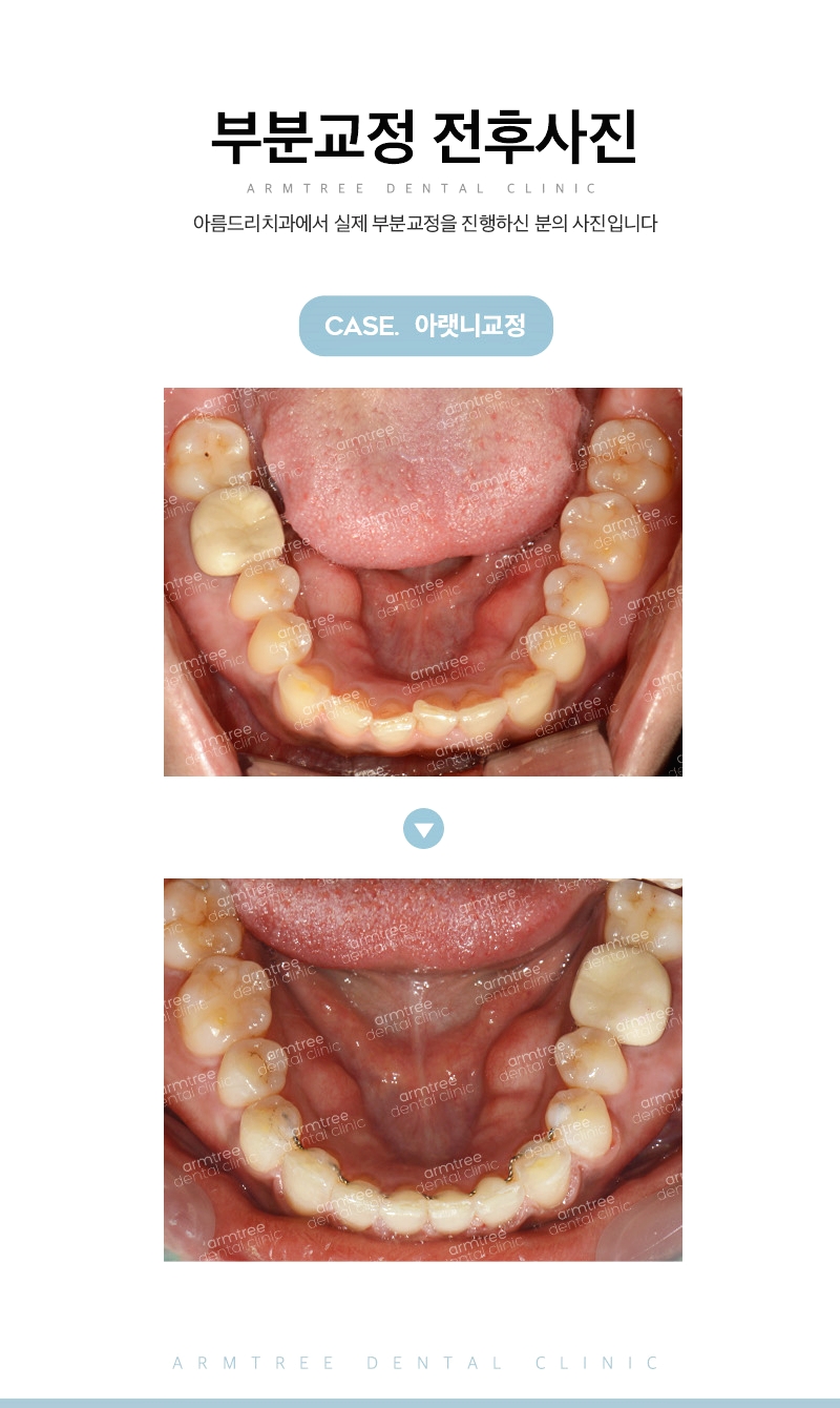 부분교정기간 신중하게 아름드리치과 관련 이미지 14