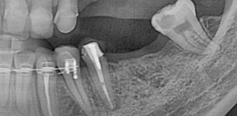 신논현역임플란트 아름드리치과에서 상악동거상술이 필요하면 관련 이미지 9