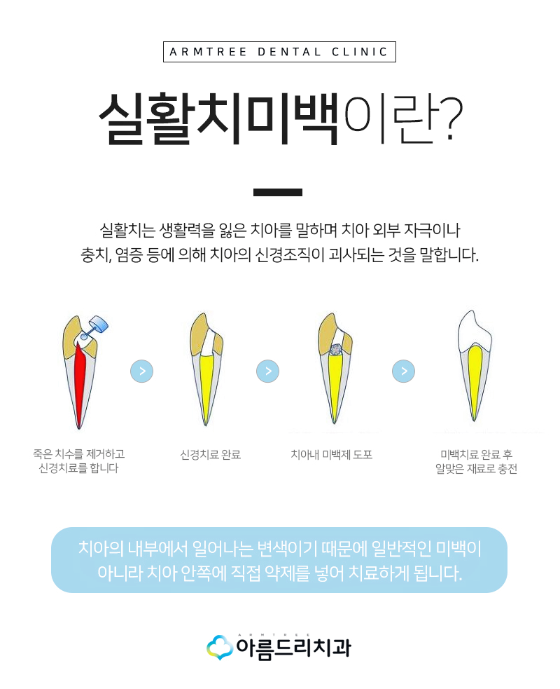 실활치미백 - 앞니변색을 해결하는 치료 관련 이미지 5